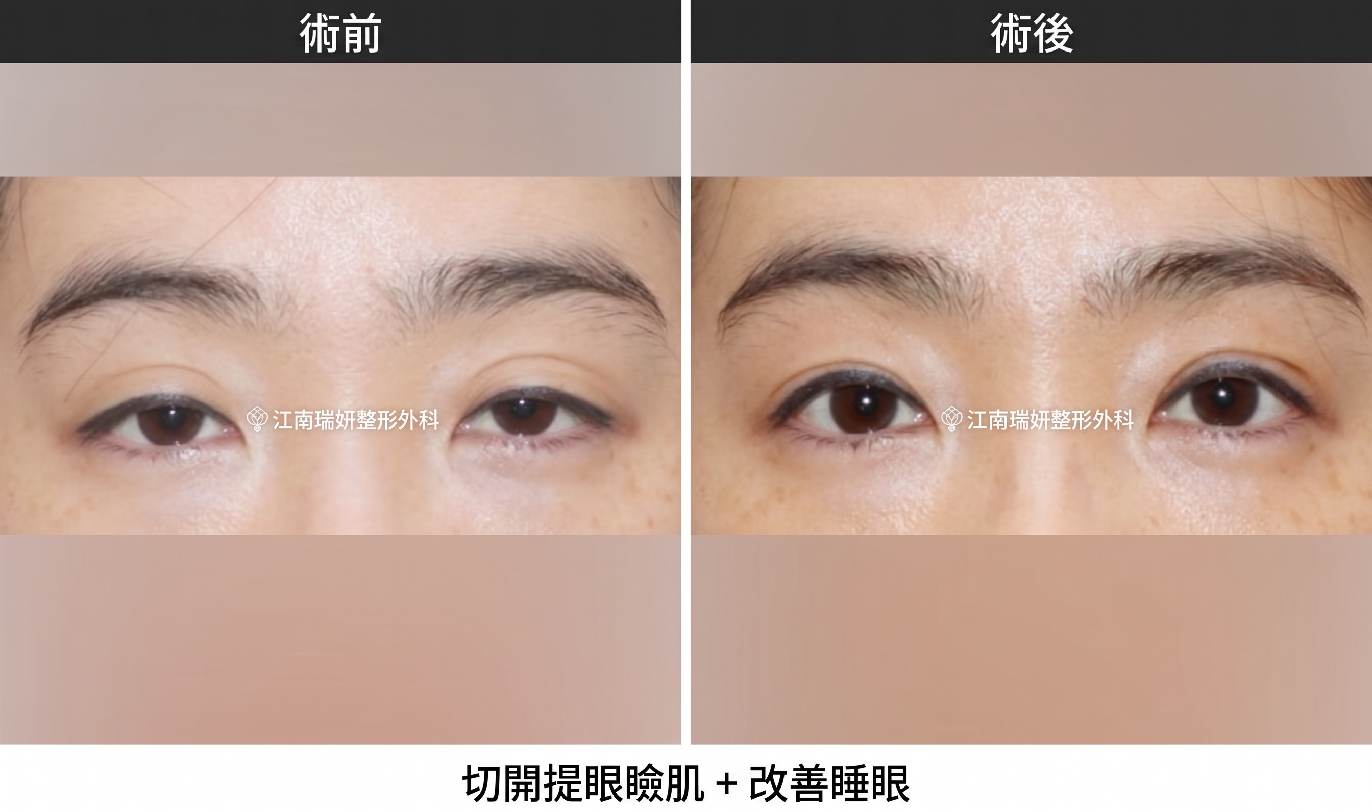 雙眼皮拆線，切開手術後必經的共同恢復階段 사진 6