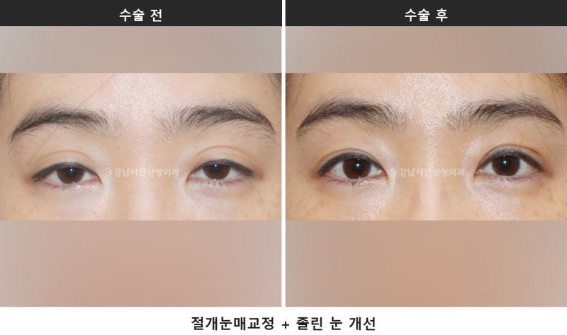 双眼皮拆线：切开手术后必经的共同恢复阶段 사진 6