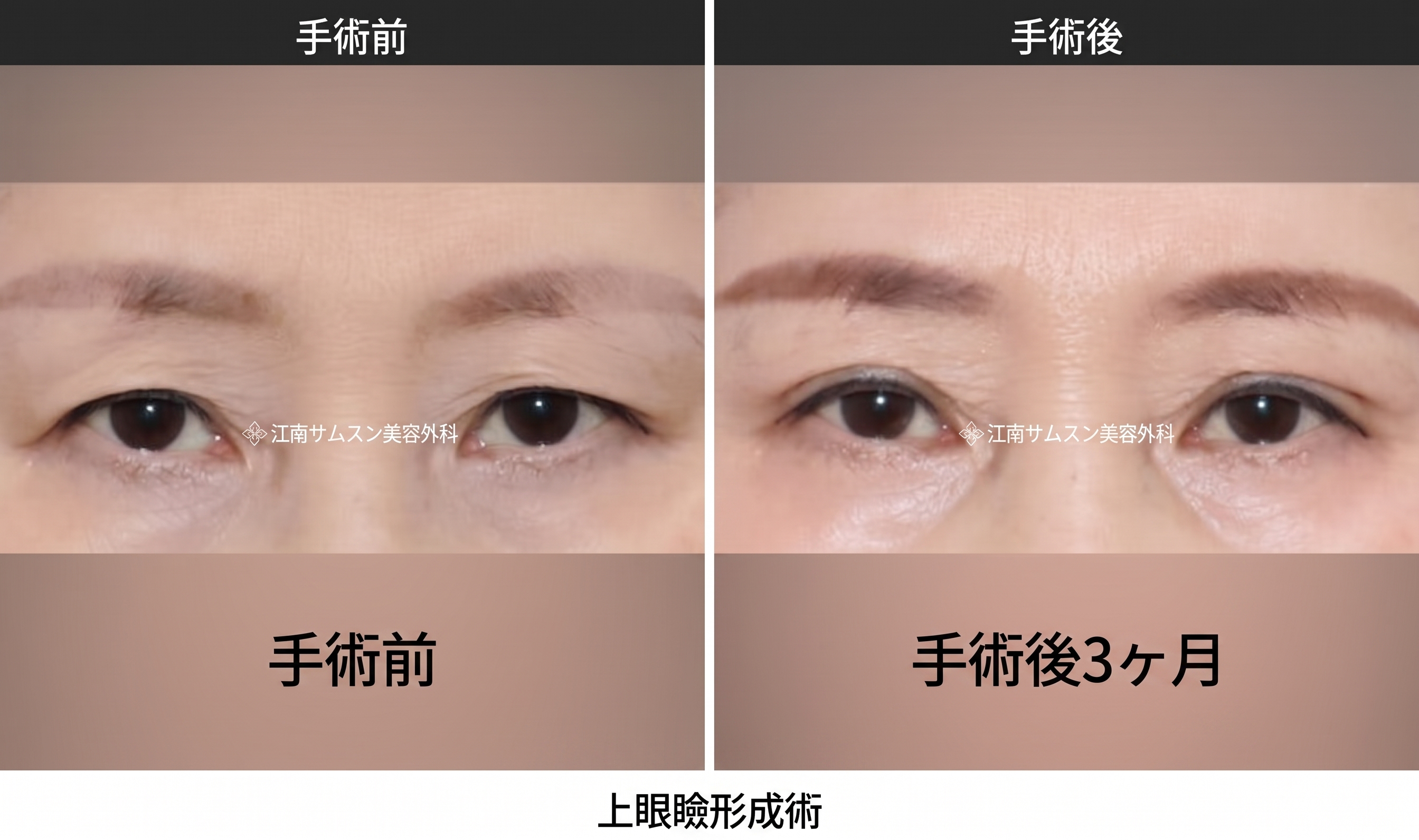 二重切開の抜糸時期と痛み・術後ケア|切開手術共通の回復プロセスを専門医が解説 사진 5