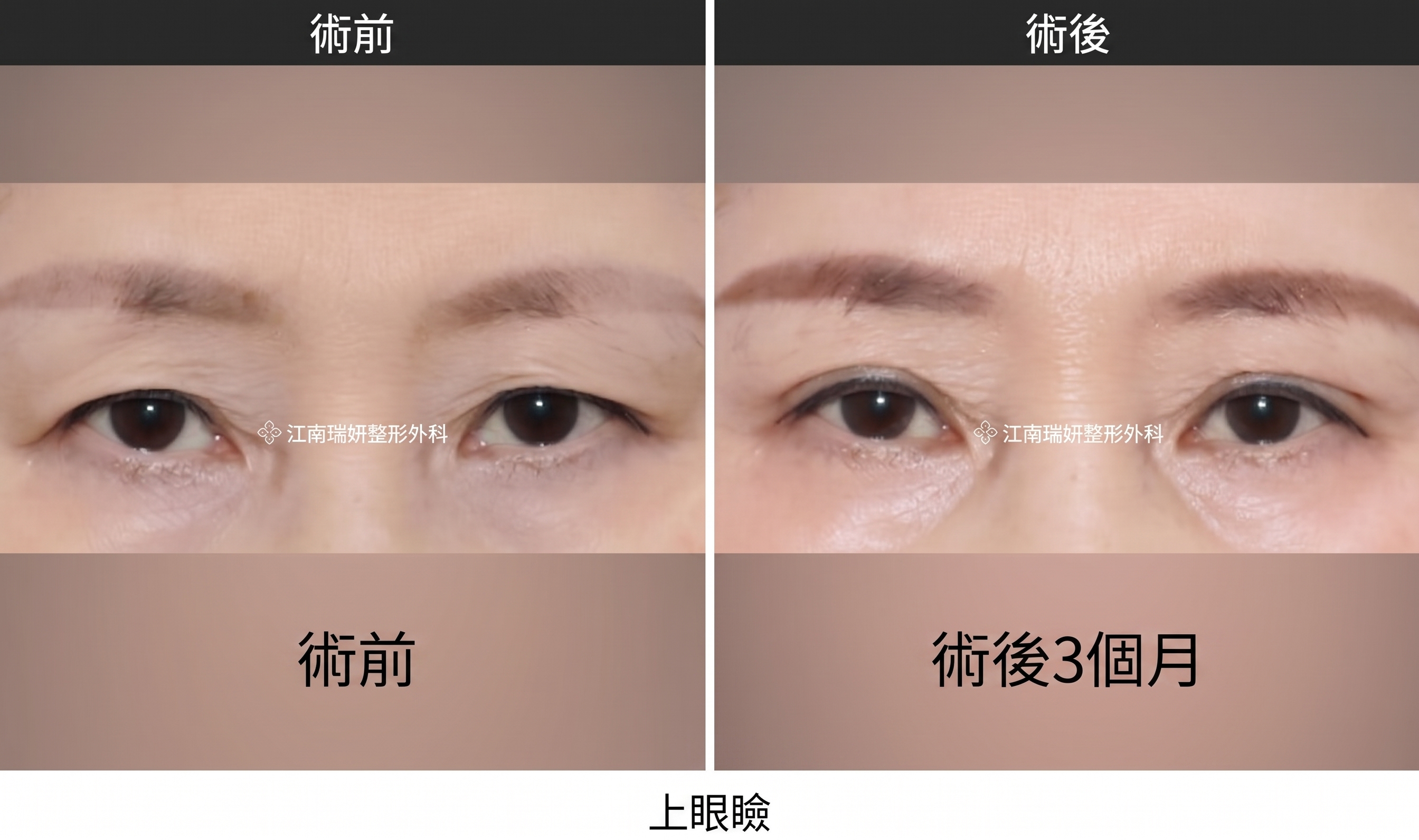 雙眼皮拆線，切開手術後必經的共同恢復階段 사진 5