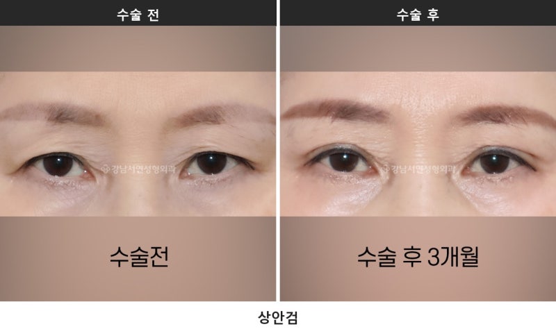 双眼皮拆线：切开手术后必经的共同恢复阶段 사진 5