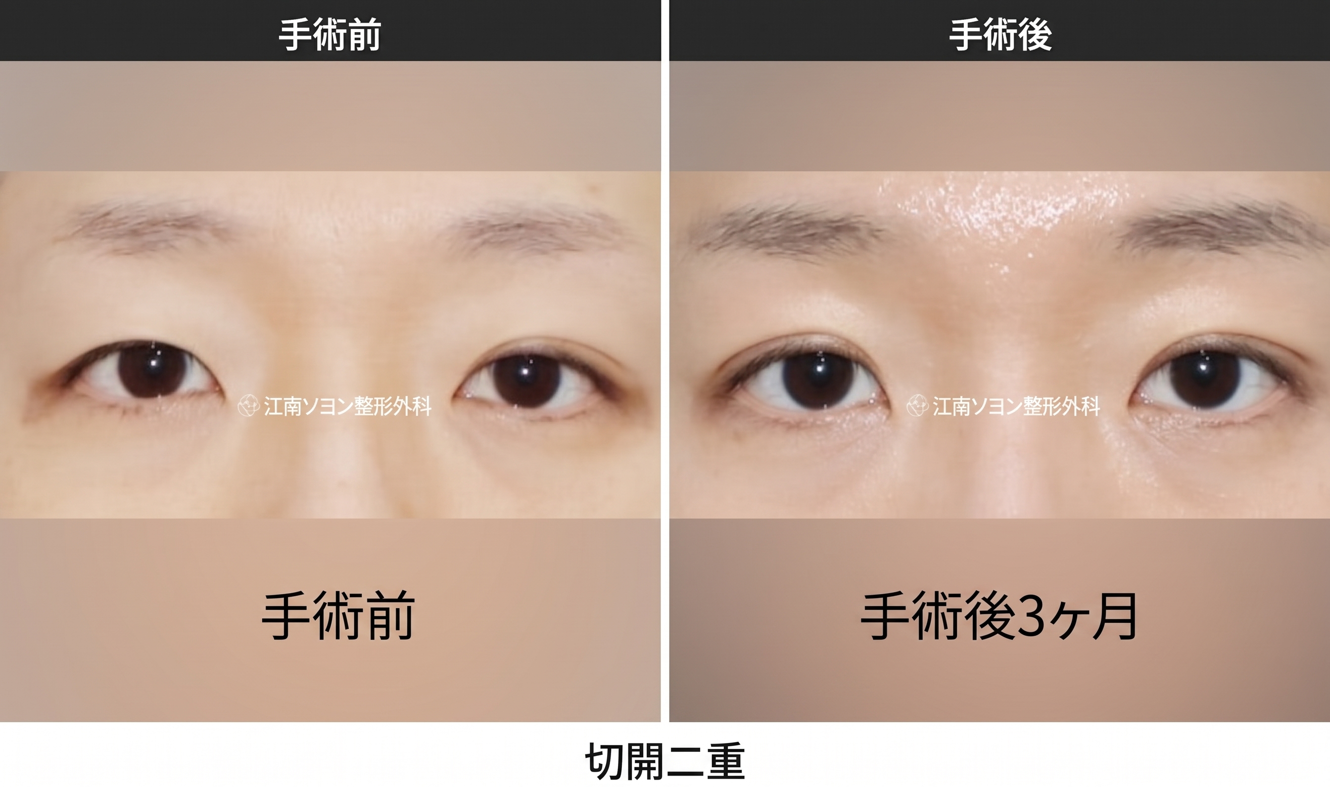 二重切開の抜糸時期と痛み・術後ケア|切開手術共通の回復プロセスを専門医が解説