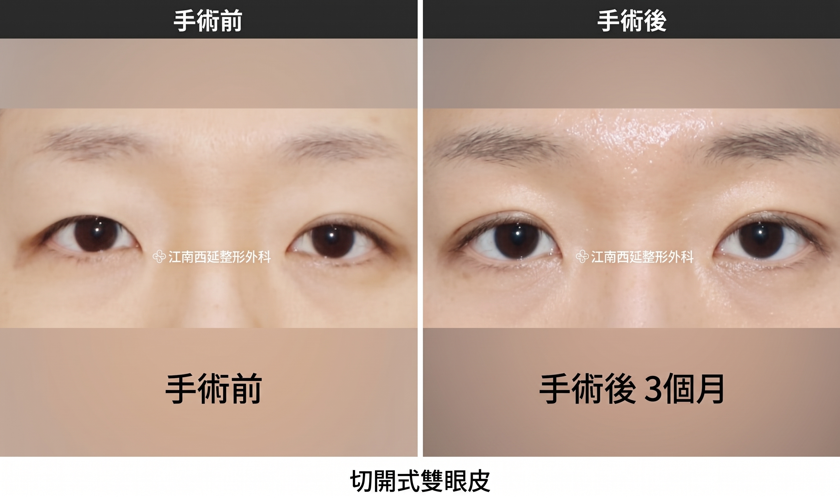 雙眼皮拆線，切開手術後必經的共同恢復階段