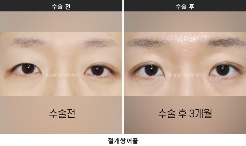 쌍수 실밥 제거, 절개 수술 후 공통으로 거치는 회복 단계입니다