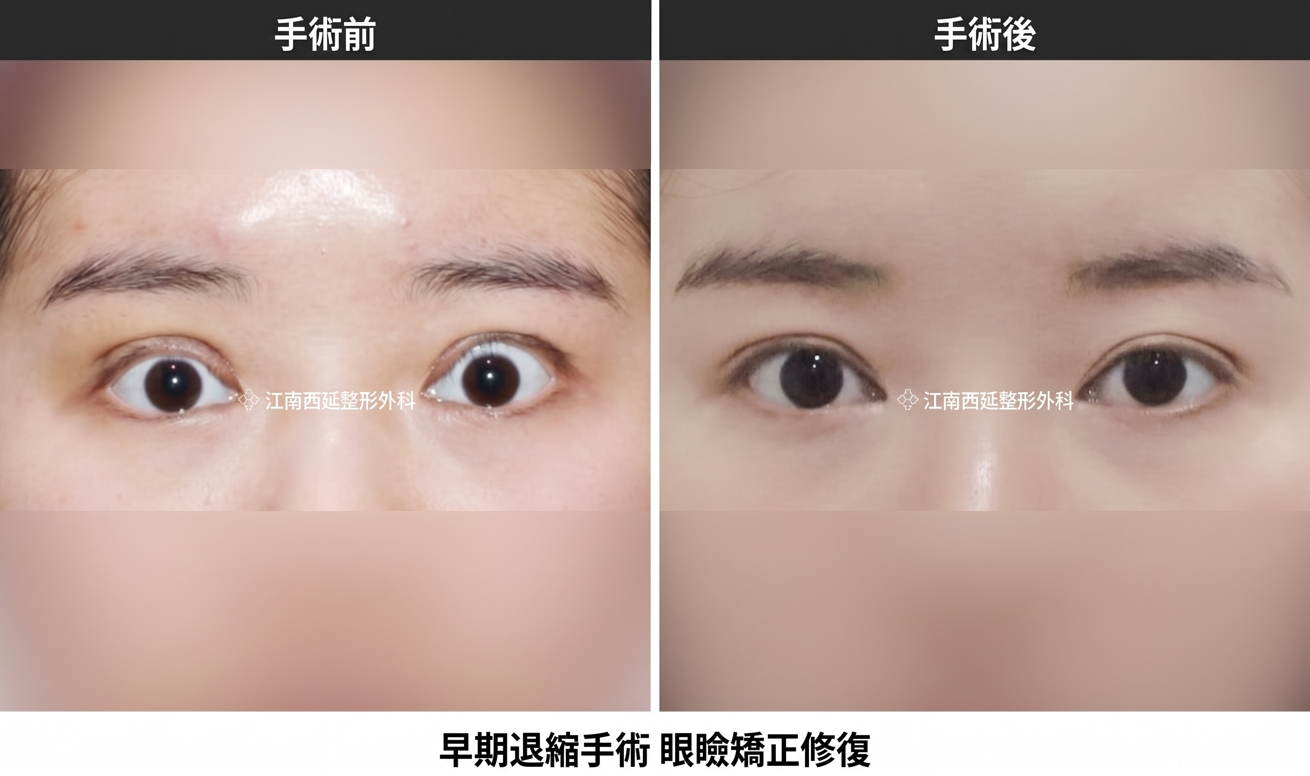 雙眼皮手術失敗、提眼肌過度矯正、多層摺痕，把握黃金期早期修復是可行的 사진 3