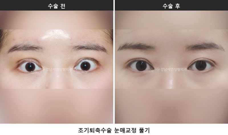 망한 쌍수, 눈매교정 과교정·겹주름, 조기교정 골든타임 안에 가능합니다