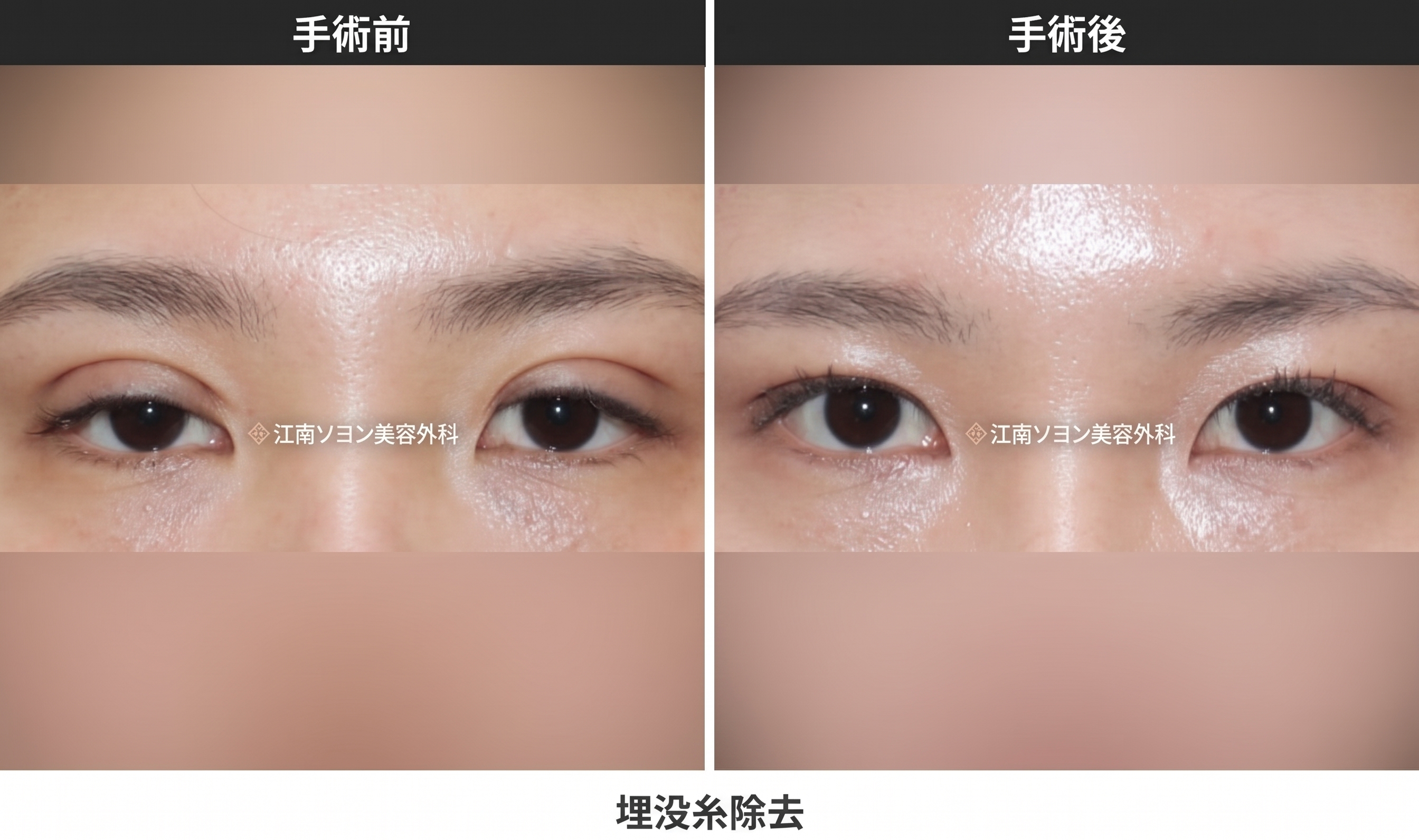 失敗した二重修正・早く戻す方法 — 早期矯正と埋没糸の抜去_切開法・埋没法の失敗修正 사진 3