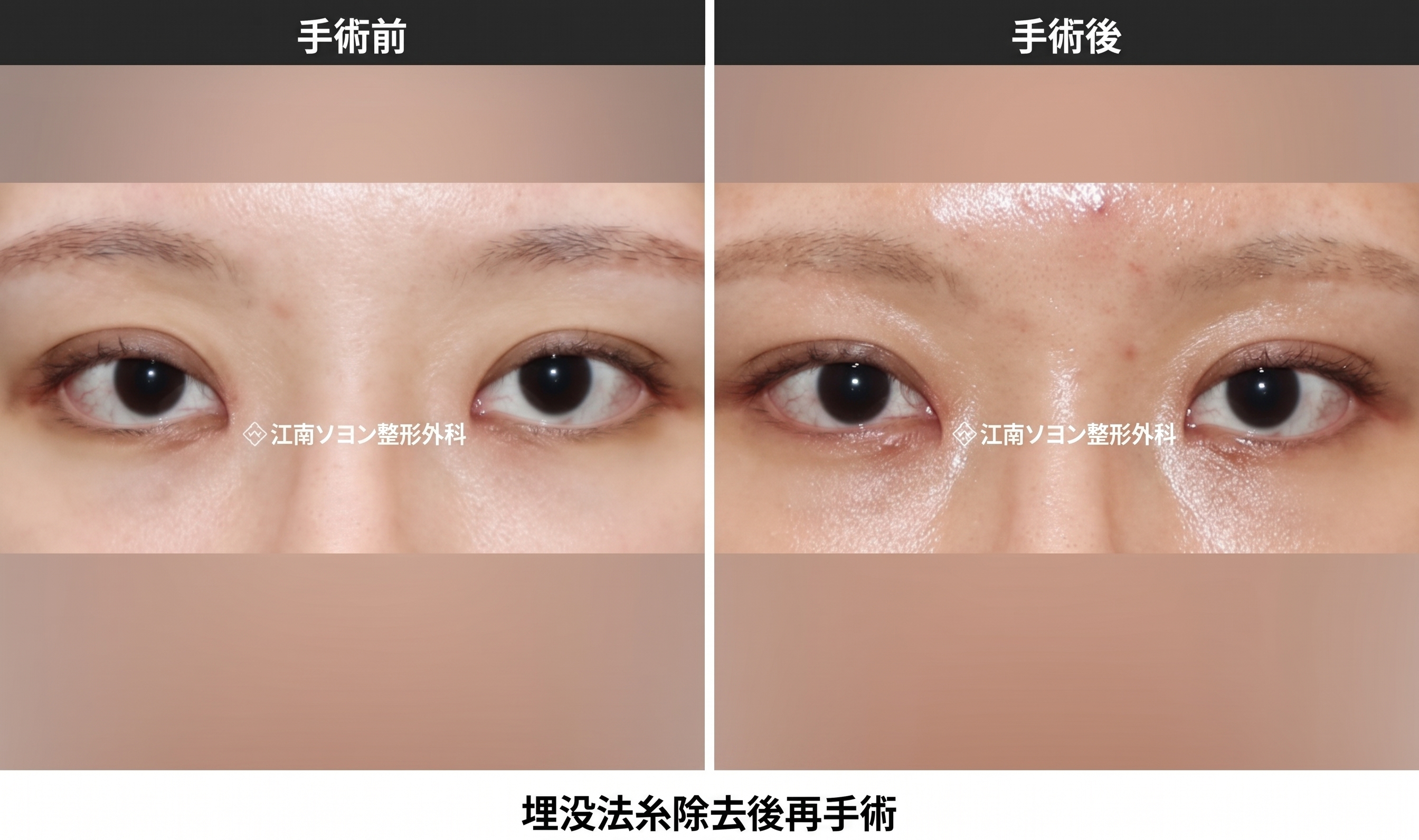失敗した二重修正・早く戻す方法 — 早期矯正と埋没糸の抜去_切開法・埋没法の失敗修正 사진 4