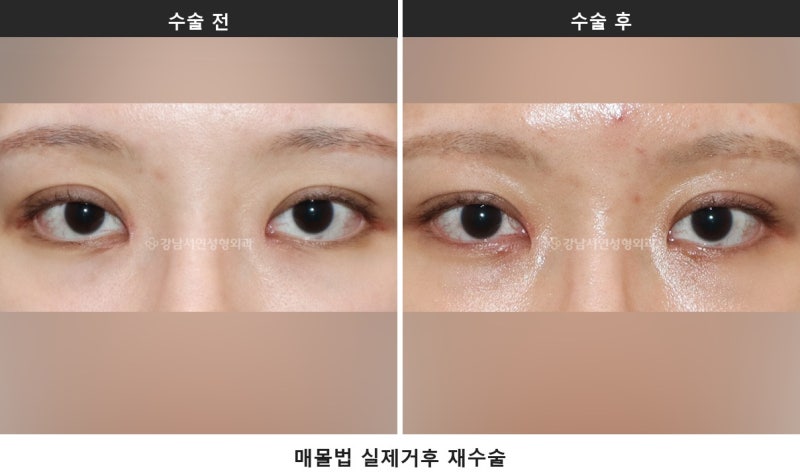 雙眼皮手術失敗重修，快速鬆解方法 — 早期矯正與埋線拆除_割雙眼皮失敗、埋線失敗 사진 4