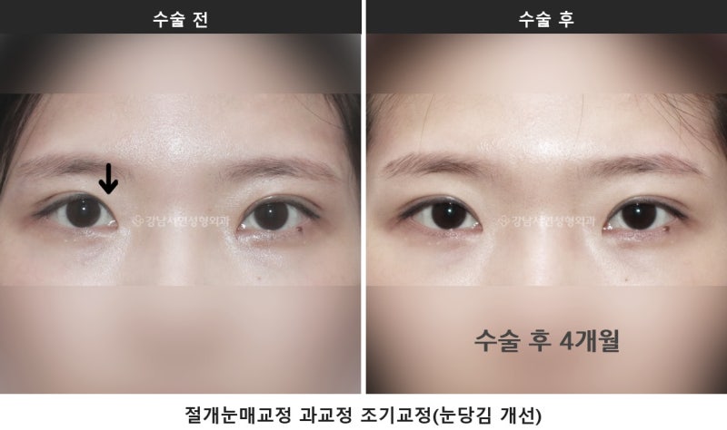 조기교정으로 해결하는 다양한 케이스들_쌍꺼풀 수술 사진 3