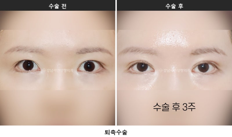 안검퇴축, 왜 생기고 어떻게 교정하나요 사진 5
