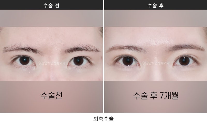 안검퇴축, 왜 생기고 어떻게 교정하나요 사진 3
