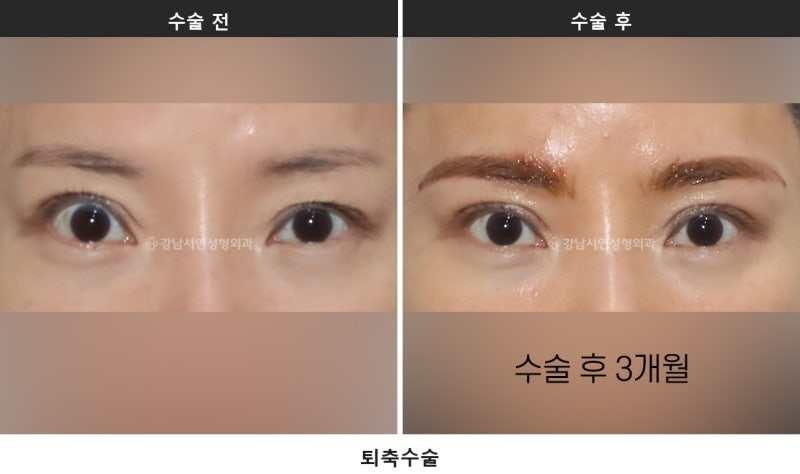안검퇴축, 왜 생기고 어떻게 교정하나요 사진 4