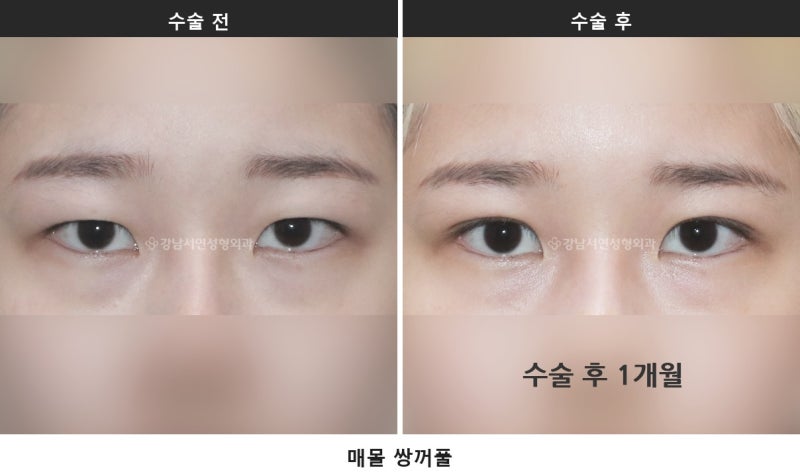 쌍수하기 좋은 계절, 여름과 겨울 중 언제가 나을까요 사진 2