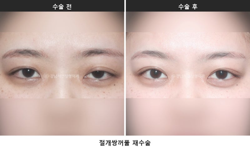 쌍수하기 좋은 계절, 여름과 겨울 중 언제가 나을까요 사진 4