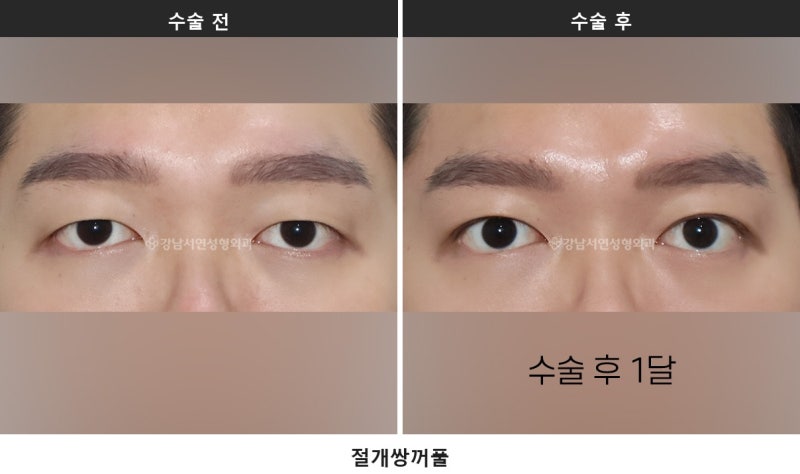 쌍수하기 좋은 계절, 여름과 겨울 중 언제가 나을까요