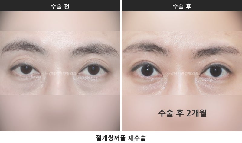 쌍수하기 좋은 계절, 여름과 겨울 중 언제가 나을까요 사진 5