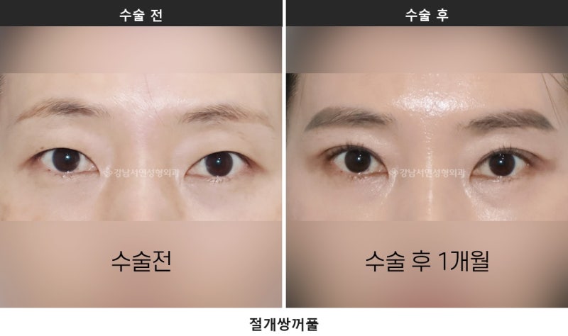 쌍수하기 좋은 계절, 여름과 겨울 중 언제가 나을까요 사진 3