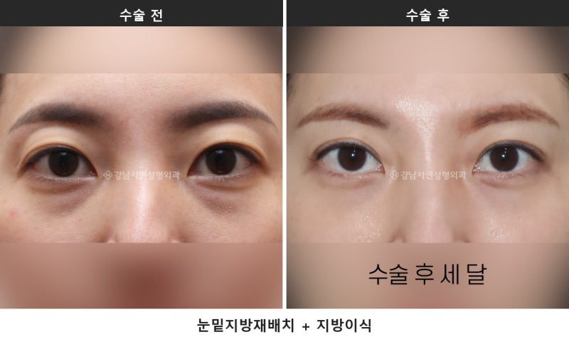쌍수하기 좋은 계절, 여름과 겨울 중 언제가 나을까요 사진 8