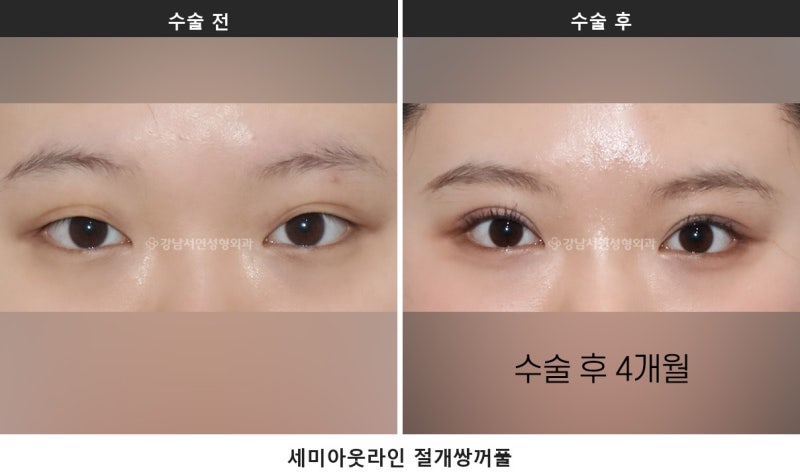 쌍수하기 좋은 계절, 여름과 겨울 중 언제가 나을까요 사진 6