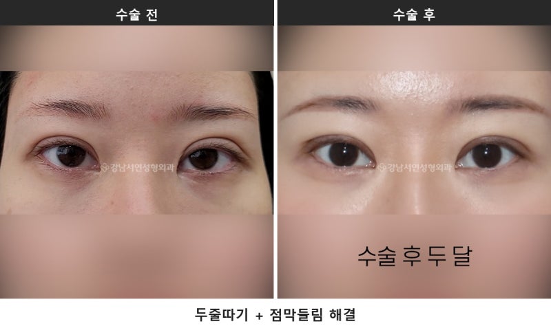 쌍수 후 점막들림, 붓기와 어떻게 구별하나요 사진 2