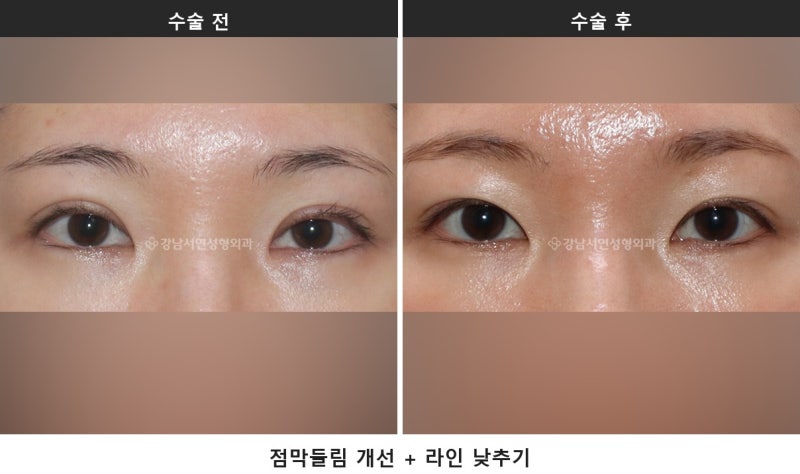 쌍수 후 점막들림, 붓기와 어떻게 구별하나요 사진 3