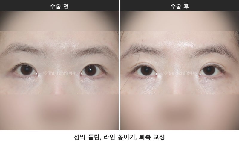 쌍수 후 점막들림, 붓기와 어떻게 구별하나요 사진 4