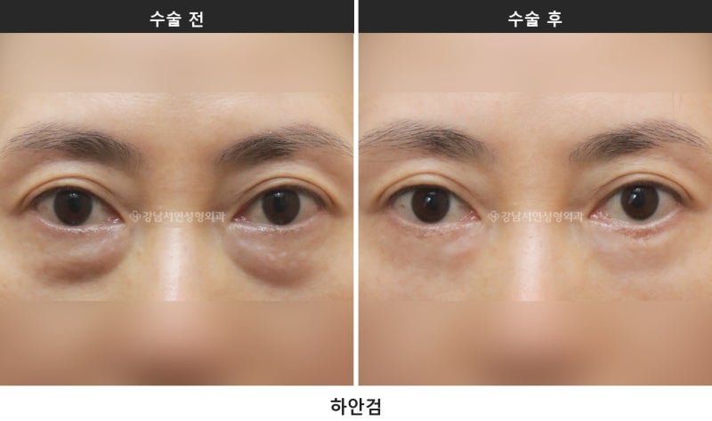 하안검과 눈밑지방재배치, 무엇이 다를까요 사진 3