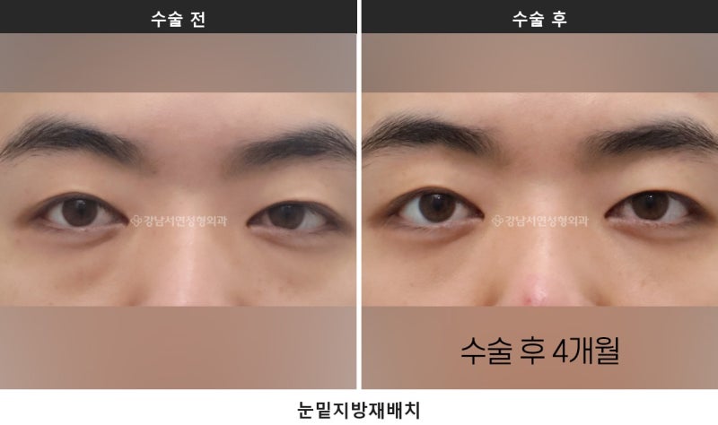 하안검과 눈밑지방재배치, 무엇이 다를까요 사진 2