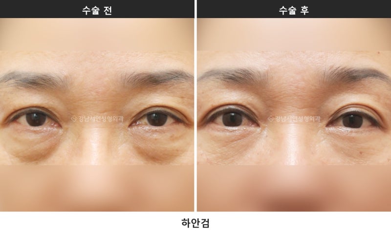 하안검과 눈밑지방재배치, 무엇이 다를까요 사진 4