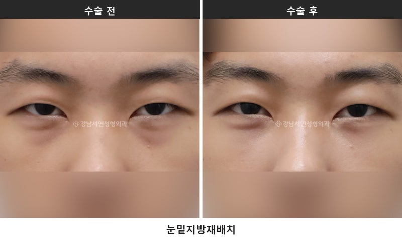 하안검과 눈밑지방재배치, 무엇이 다를까요