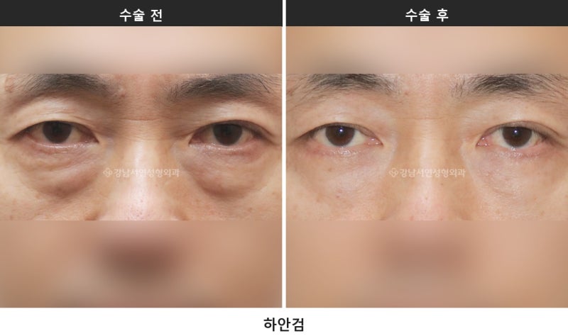 하안검과 눈밑지방재배치, 무엇이 다를까요 사진 5