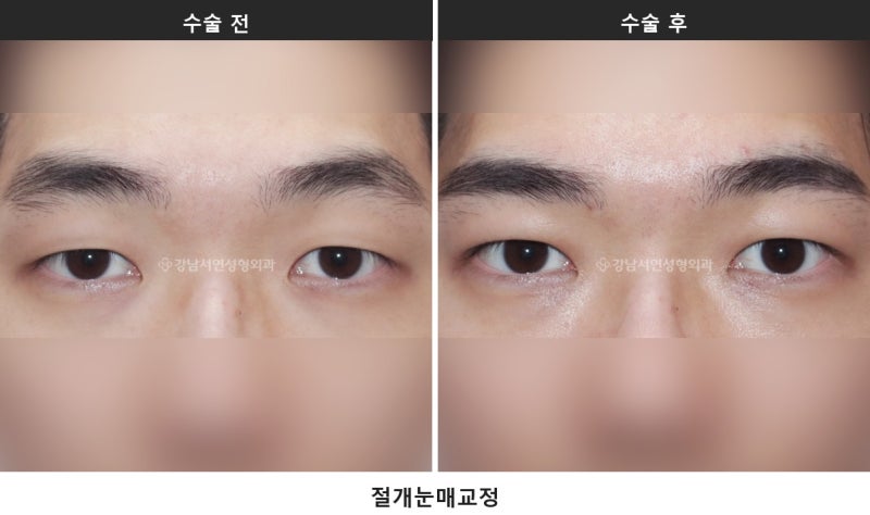 눈매교정술, 눈 뜨는 힘을 바로잡는 수술입니다 사진 5