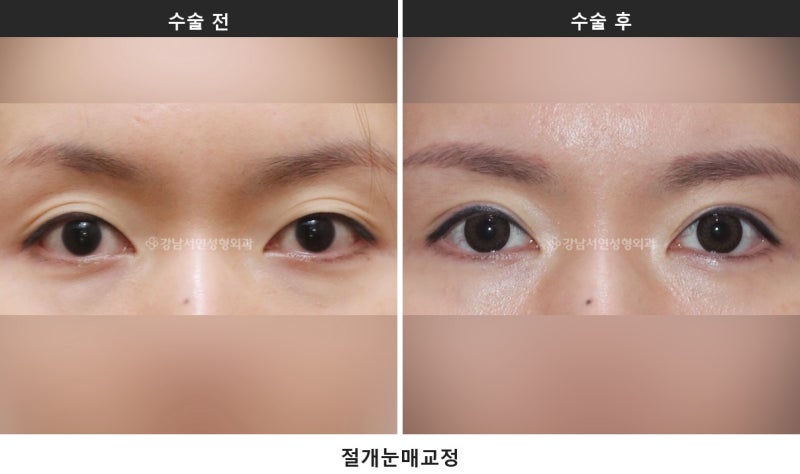 눈매교정술, 눈 뜨는 힘을 바로잡는 수술입니다