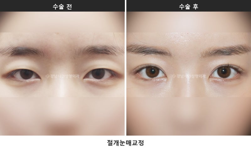 눈매교정술, 눈 뜨는 힘을 바로잡는 수술입니다 사진 3