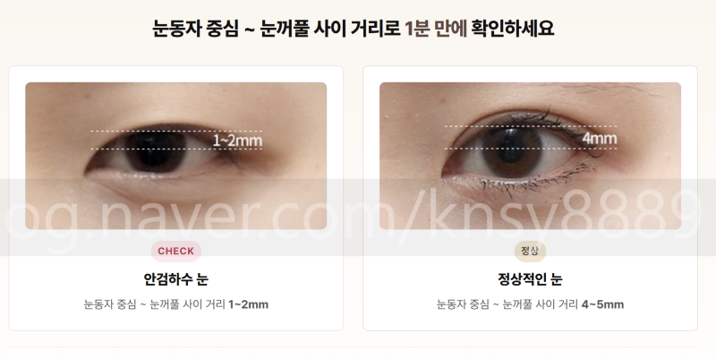 눈매교정술, 눈 뜨는 힘을 바로잡는 수술입니다 사진 2