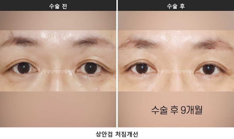 중년 눈성형 종류, 상안검·하안검·눈썹하거상 어떻게 다를까요