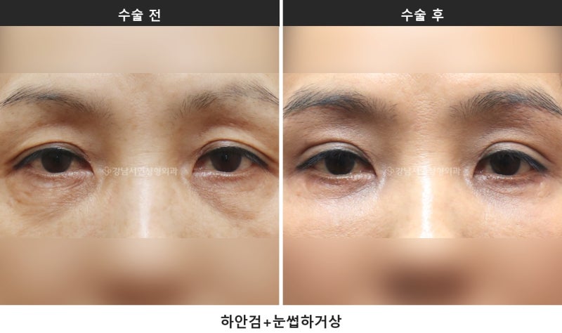 중년 눈성형 종류, 상안검·하안검·눈썹하거상 어떻게 다를까요 사진 5