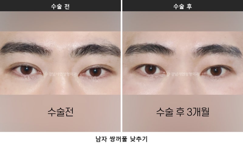 남자 무쌍눈매교정과 라인 낮추기, 한 번에 정리합니다 사진 6