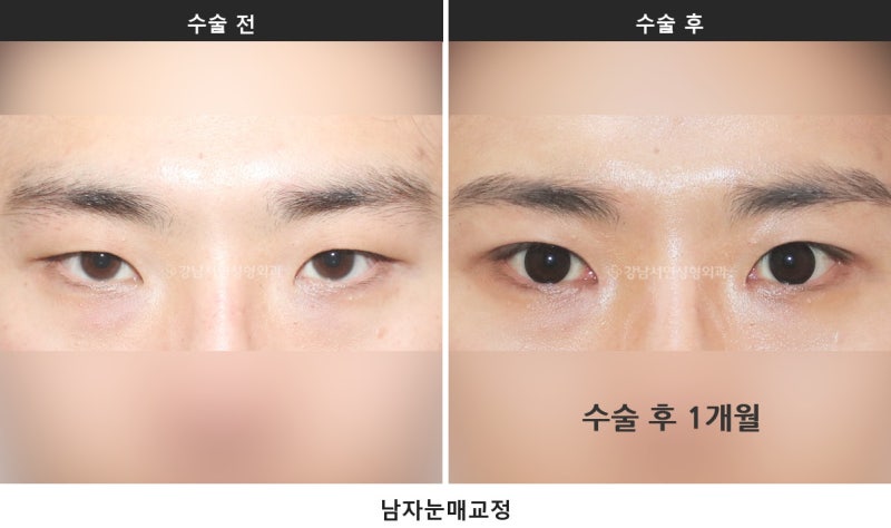 남자 무쌍눈매교정과 라인 낮추기, 한 번에 정리합니다 사진 4