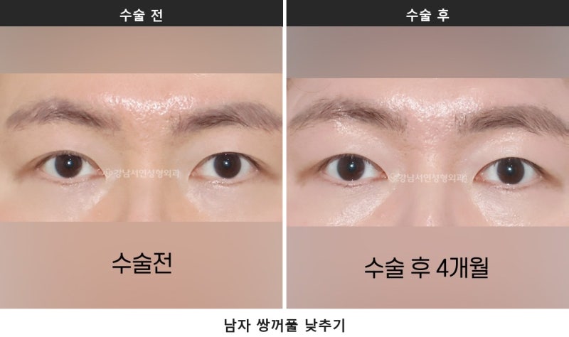 남자 무쌍눈매교정과 라인 낮추기, 한 번에 정리합니다 사진 7