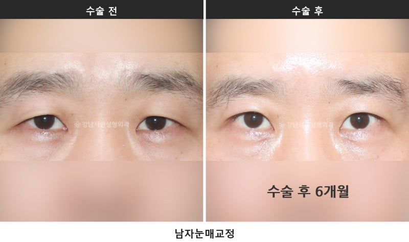 남자 무쌍눈매교정과 라인 낮추기, 한 번에 정리합니다 사진 3