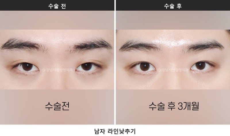 남자 무쌍눈매교정과 라인 낮추기, 한 번에 정리합니다 사진 5