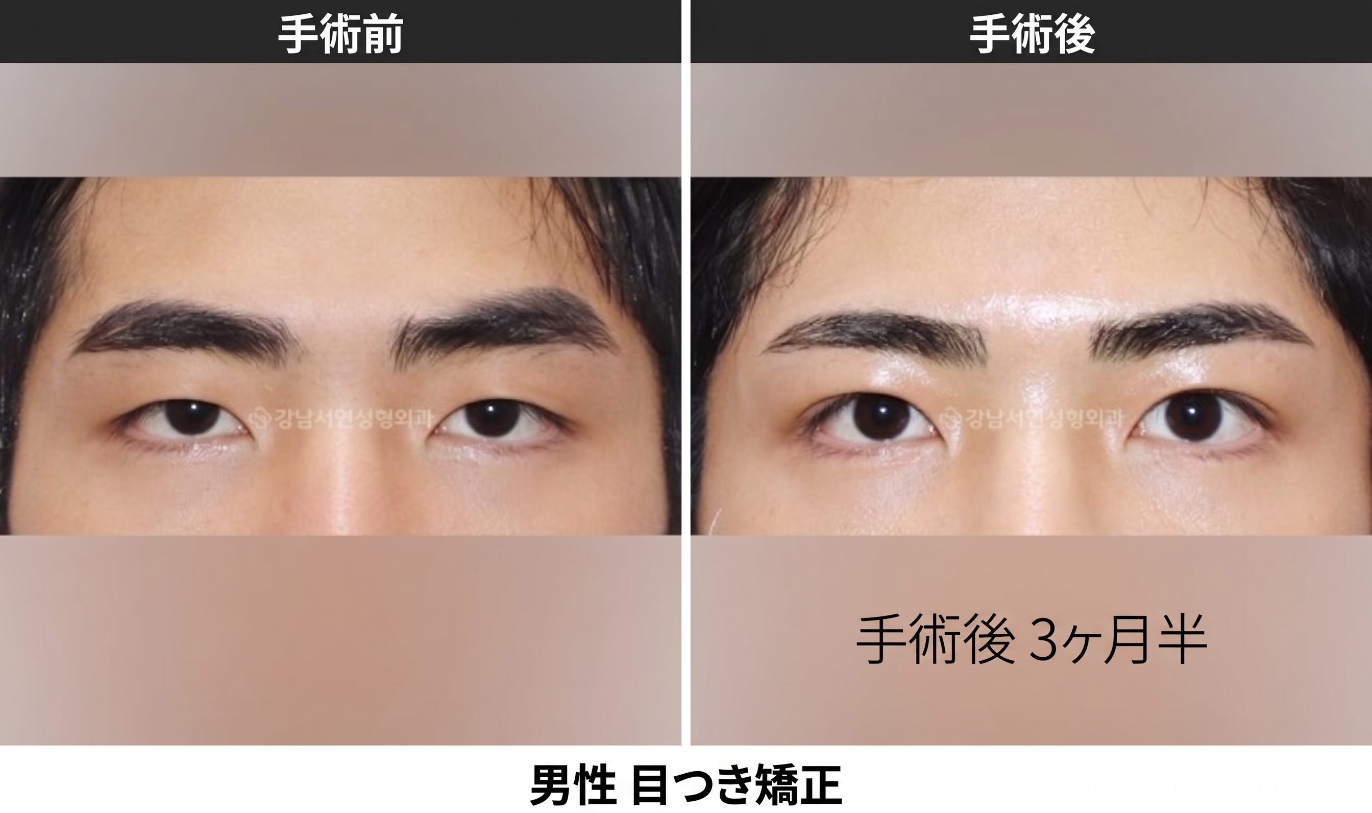 男性の無重瞼目元矯正とラインダウン、まとめて解説します