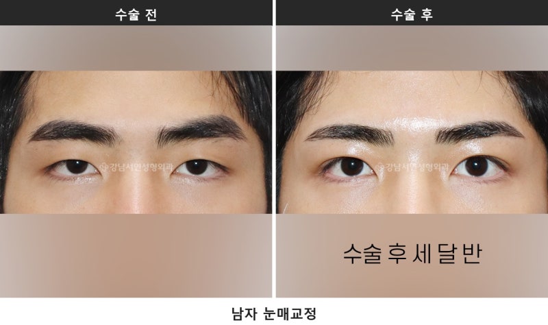 남자 무쌍눈매교정과 라인 낮추기, 한 번에 정리합니다