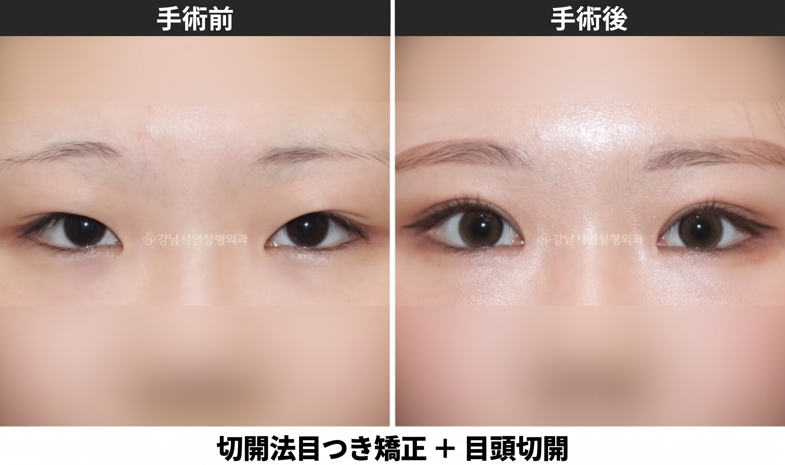 目頭切開と目元矯正の併用で、すっきり爽やかな目元をつくる組み合わせです