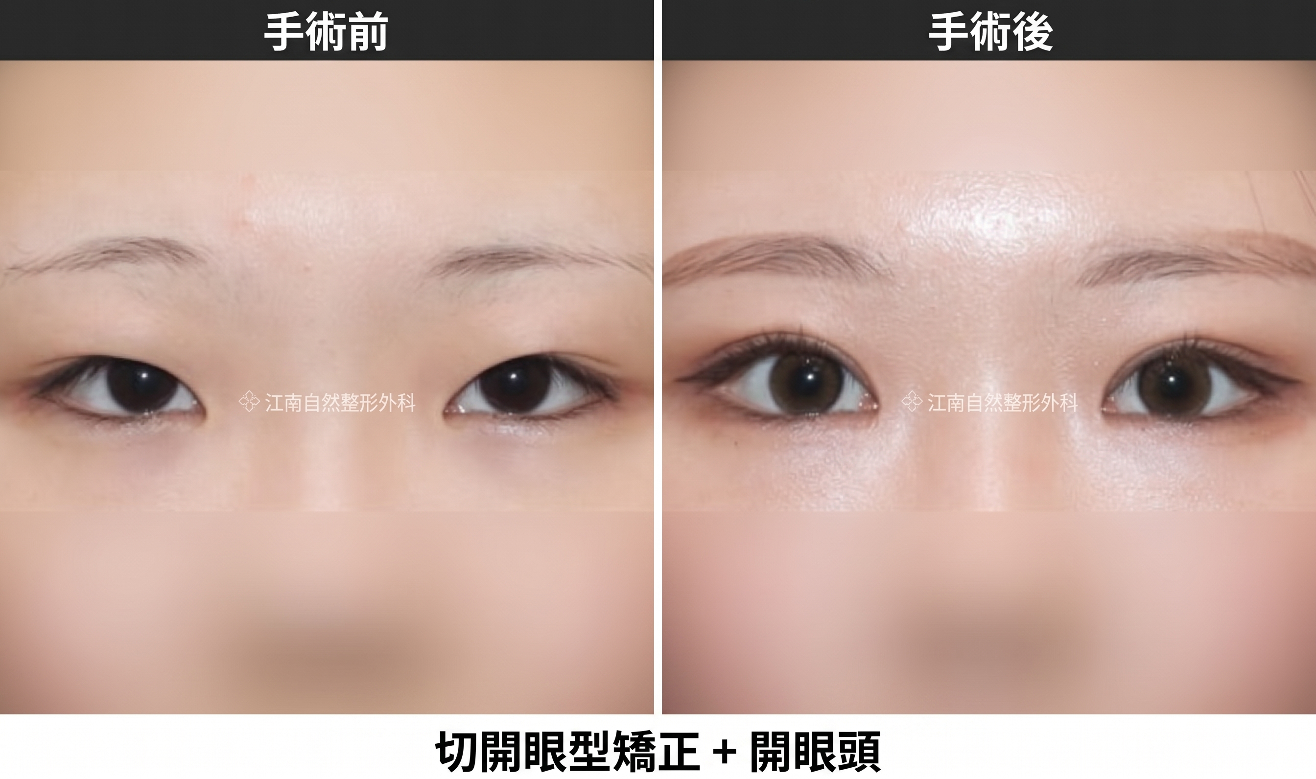開眼頭併行眼型矯正，打造清爽眼型的組合