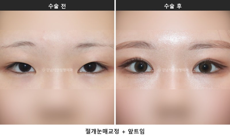 앞트임과 눈매교정 병행, 시원한 눈매를 만드는 조합입니다