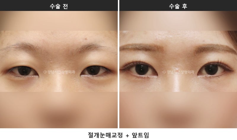 앞트임과 눈매교정 병행, 시원한 눈매를 만드는 조합입니다 사진 4