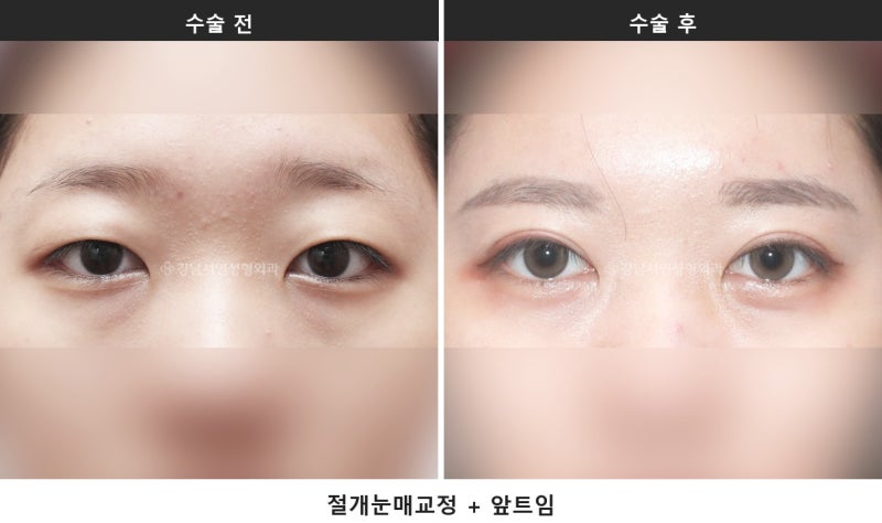 앞트임과 눈매교정 병행, 시원한 눈매를 만드는 조합입니다 사진 5
